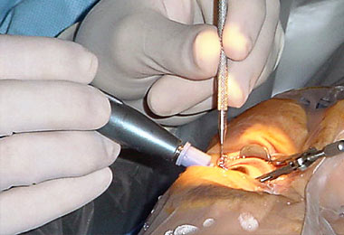 Retina surgeries